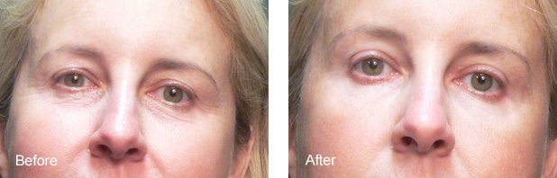 UNDER EYE WRINKLES TREATED WITH BOTOX INJECTIONS1