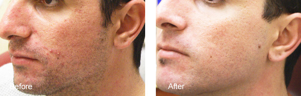 acne treated at the center1