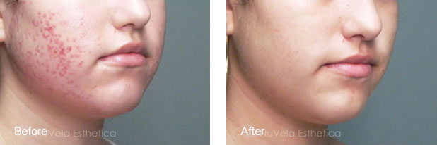 acne treatment1