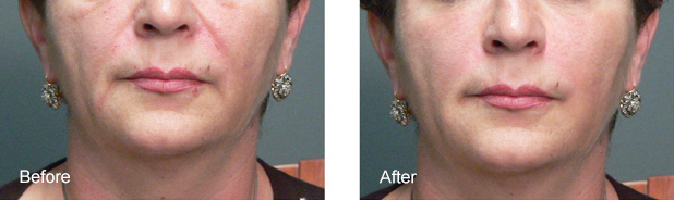 bxa SCULPTRA AESTHETIC1