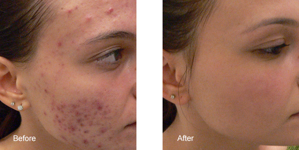 bxa acne laser1