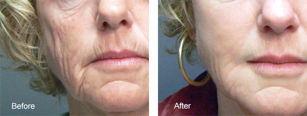 bxa facial1