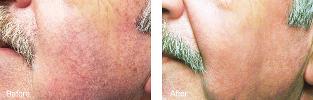 Close-up of facial spider veins on the cheek at Nu Vela Laser Medical Spa in Los Angeles
