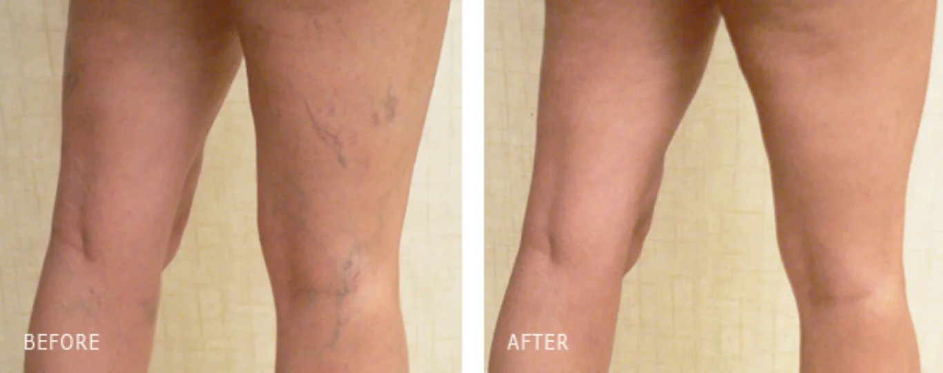 sclerotherapy spider veins before and after legs before and after sclerotherapy treatment showing cleared spider veins on the back of the legs