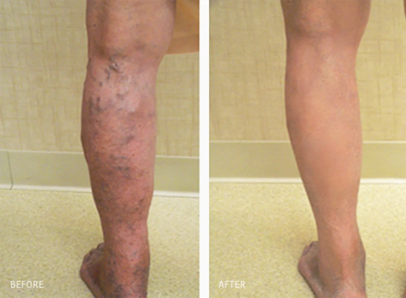 varicose vein removal before and after lower leg before and after vein removal showing severe varicose veins on the lower leg completely cleared